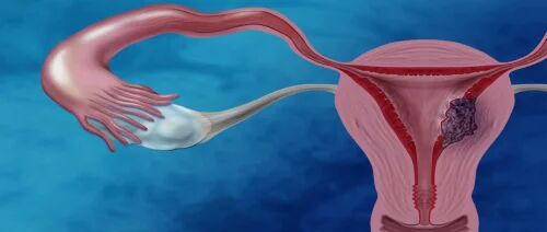 5 معلومات عن سرطان عنق الرحم الأورام الخبيثة والحميدة