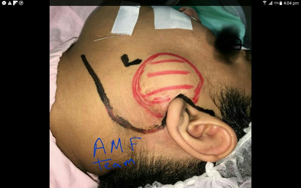 نجاح أطباء قسم جراحة الوجه بالاسكندرية من استئصال ورم حميد بالوجة
